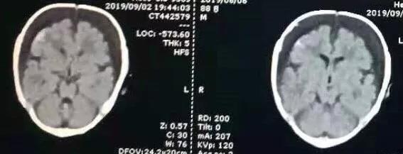 两个月大的男婴皮肤白皙、头发“自然卷”，医生却说孩子是患病了