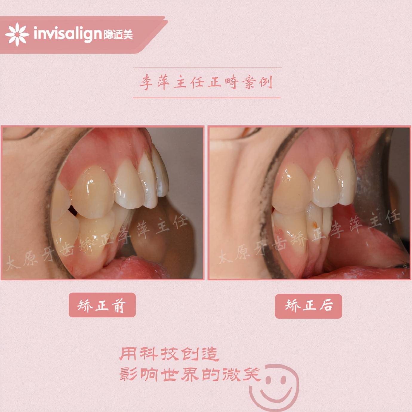 二甲医院骨性前突龅牙矫正多少钱,太原骨性嘴凸矫正牙齿图片