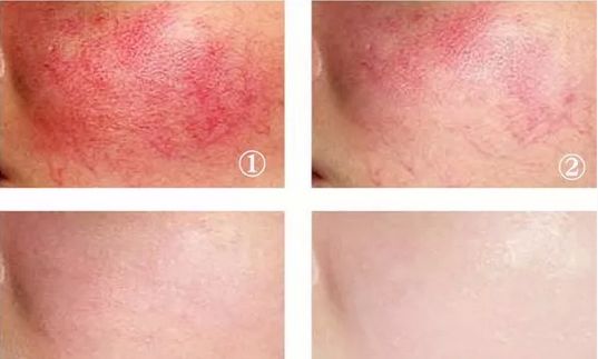 红血丝皮肤护理方案话术,红血丝肌肤的护理方法