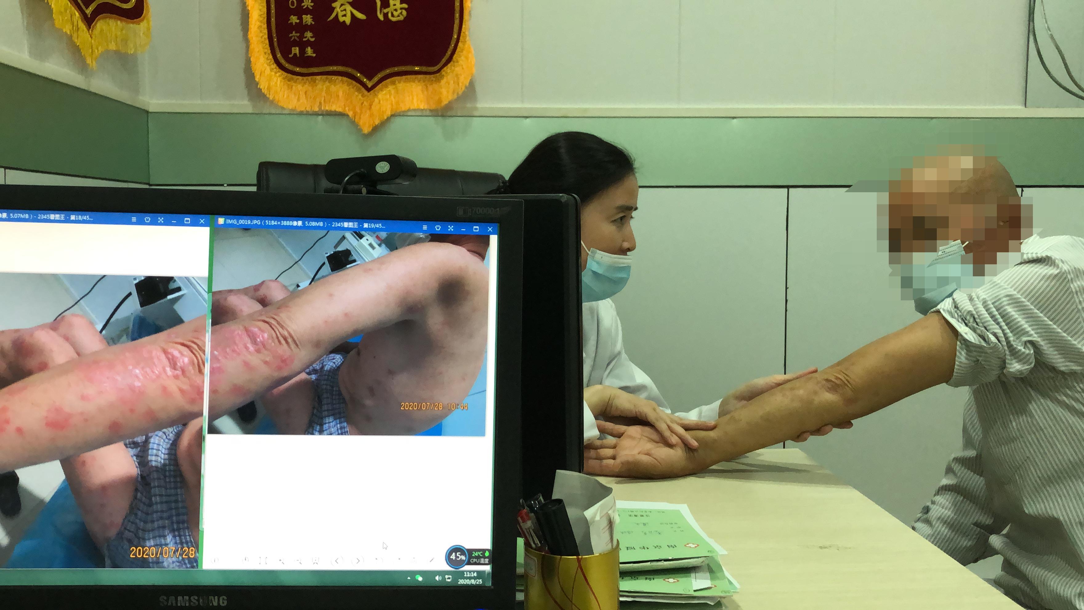 南京42岁中层领导查出银屑病加重，原因则是这把枸杞