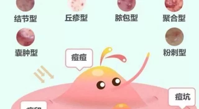 痘痘肌必备的消痘神器,秋冬战痘神器推荐