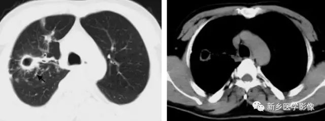 肺部基础免疫,肺基础疾病有哪些