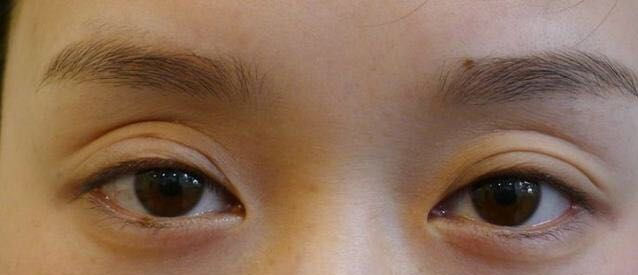 改善三眼皮的方法,眼皮成了三眼皮的原因