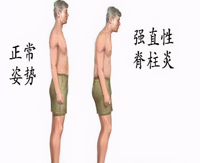 强直性脊柱炎运动需要注意什么,强直性脊柱炎健身训练注意事项