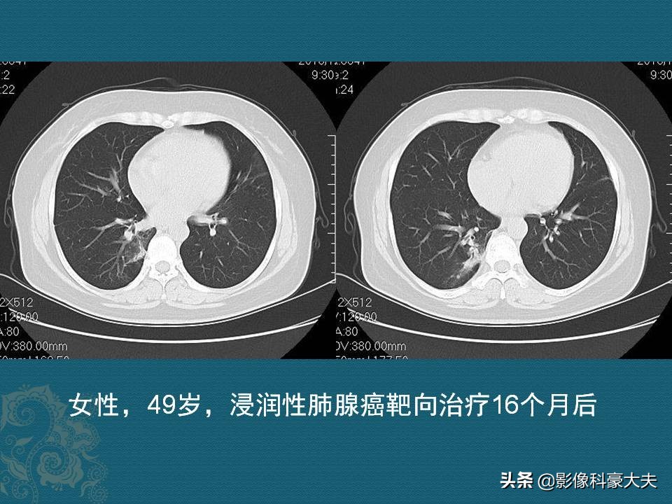 昂贵靶向药有必要吗,昂贵的靶向药真的好吗