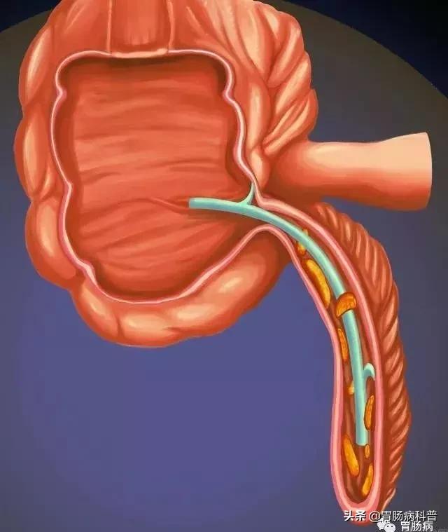 阑尾炎最新内镜微创手术,内镜下阑尾炎治疗术哪里可以做