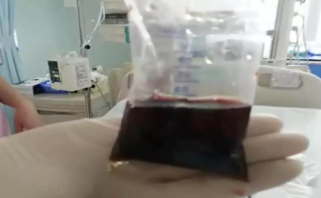 3岁小孩晨起尿呈酱油色怎么回事,3岁男童出现酱油尿