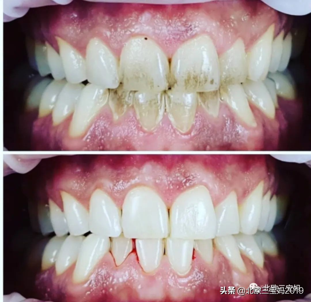 5岁小孩打全麻治蛀牙有影响吗,3岁孩子全麻风险大吗