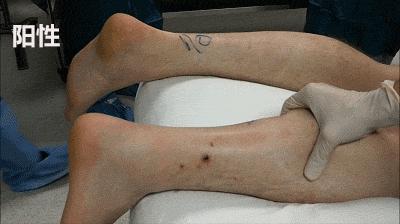 小腿感觉被人踢了跟腱断裂,踢一脚跟腱断裂