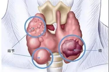 甲状腺结节频发，该拿它怎么办才好？