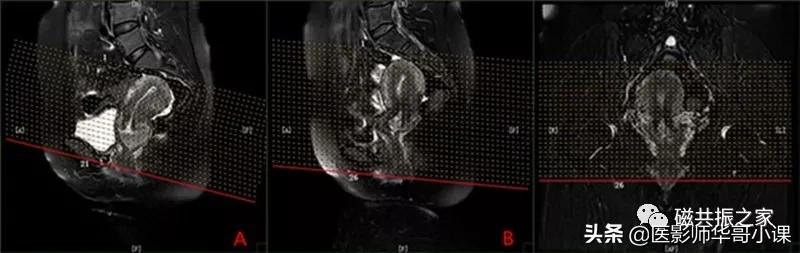 「精品课件」带大家看看,磁共振子宫MRI要如何扫描?