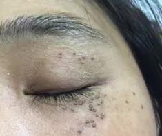 长了汗管瘤容易长皱纹,为什么会长汗管瘤和脂肪粒