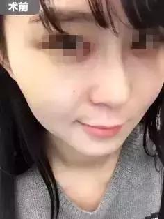 解密瘦脸针的几大常识性问题,关于瘦脸针的真实事件