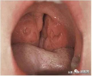 咽喉疾病科普知识,咽喉疾病动画科普视频
