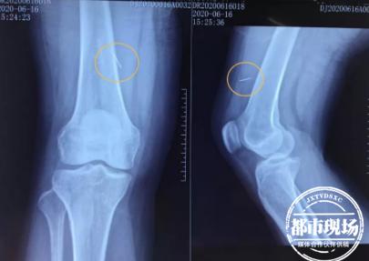 缝衣针剔牙针尖断了,缝衣针针头断了