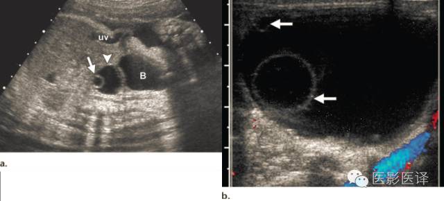 胎儿卵巢囊肿5.6厘米会消失吗,卵巢巨大囊肿与妊娠鉴别