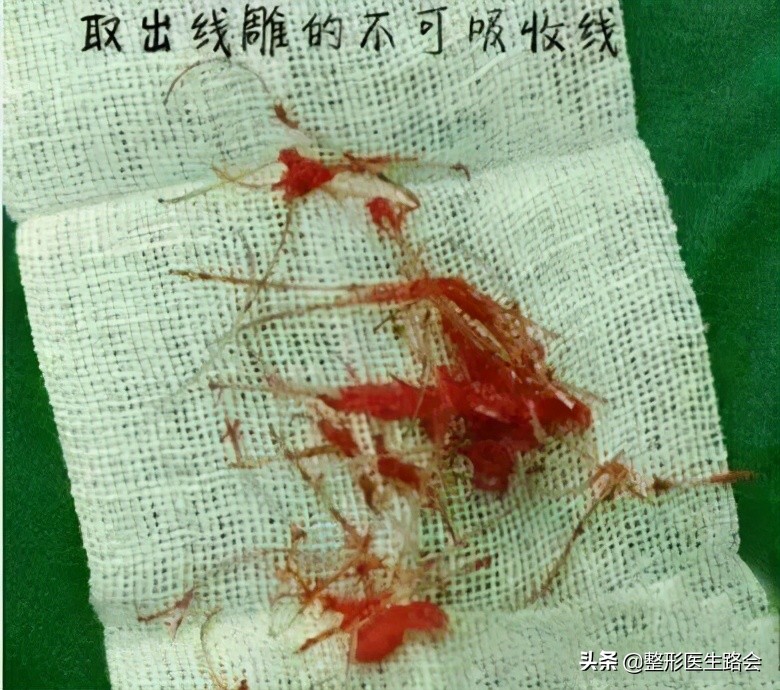 线雕隆鼻和软骨隆鼻哪个好,线雕隆鼻跟假体隆鼻哪个好看