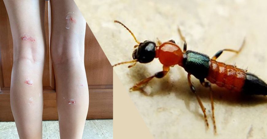 隐翅虫的毒性有多强,隐翅虫黑色的幼虫有毒吗