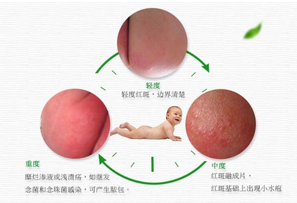 宝宝拉稀引起红屁股快速好方法,宝宝红屁股怎么办教你一招搞定