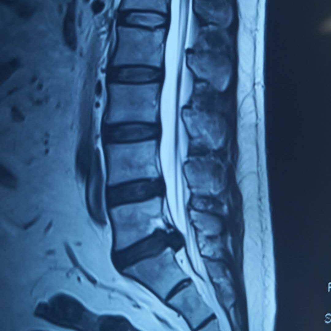 陕西椎间孔镜手术最好的医院,椎间孔镜手术陕西哪个医院做得好