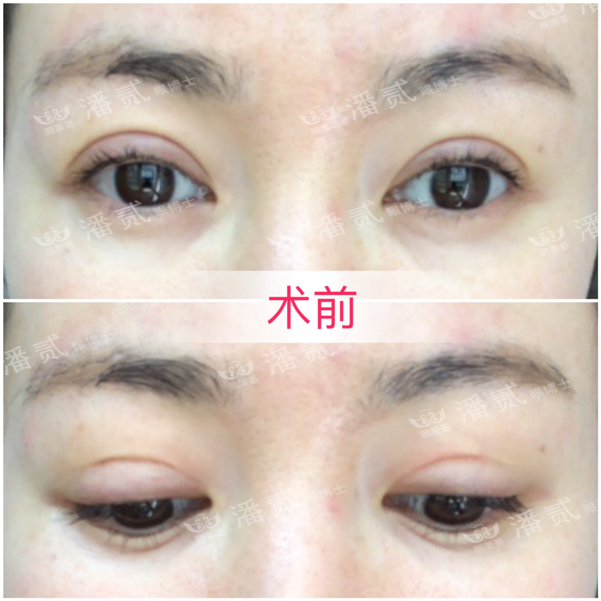 广州双眼皮修复内双,广州双眼皮修复可以只修眼尾吗