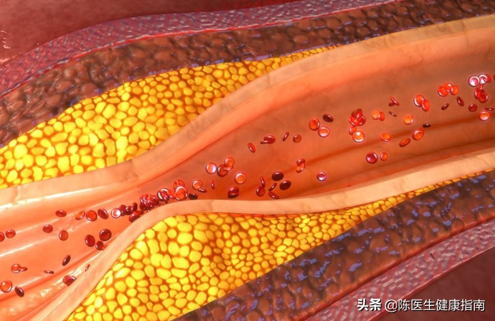 心脏支架是怎么把血管撑开的,心脏支架手术血管撕裂怎么办