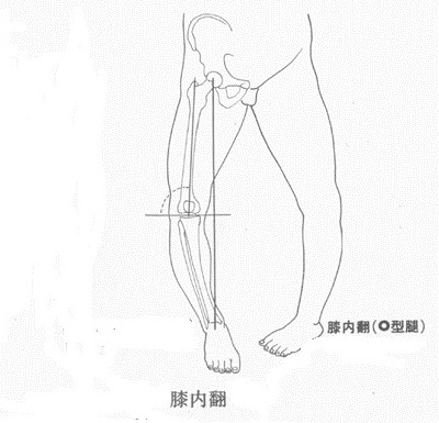 足内翻和踮脚走怎么康复,足内翻会导致什么腿型怎么改