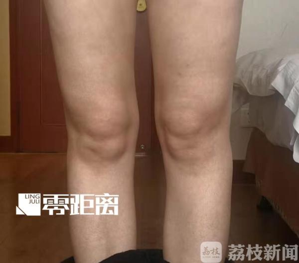 女子整形鼻子歪了失败,鼻子变歪的女人
