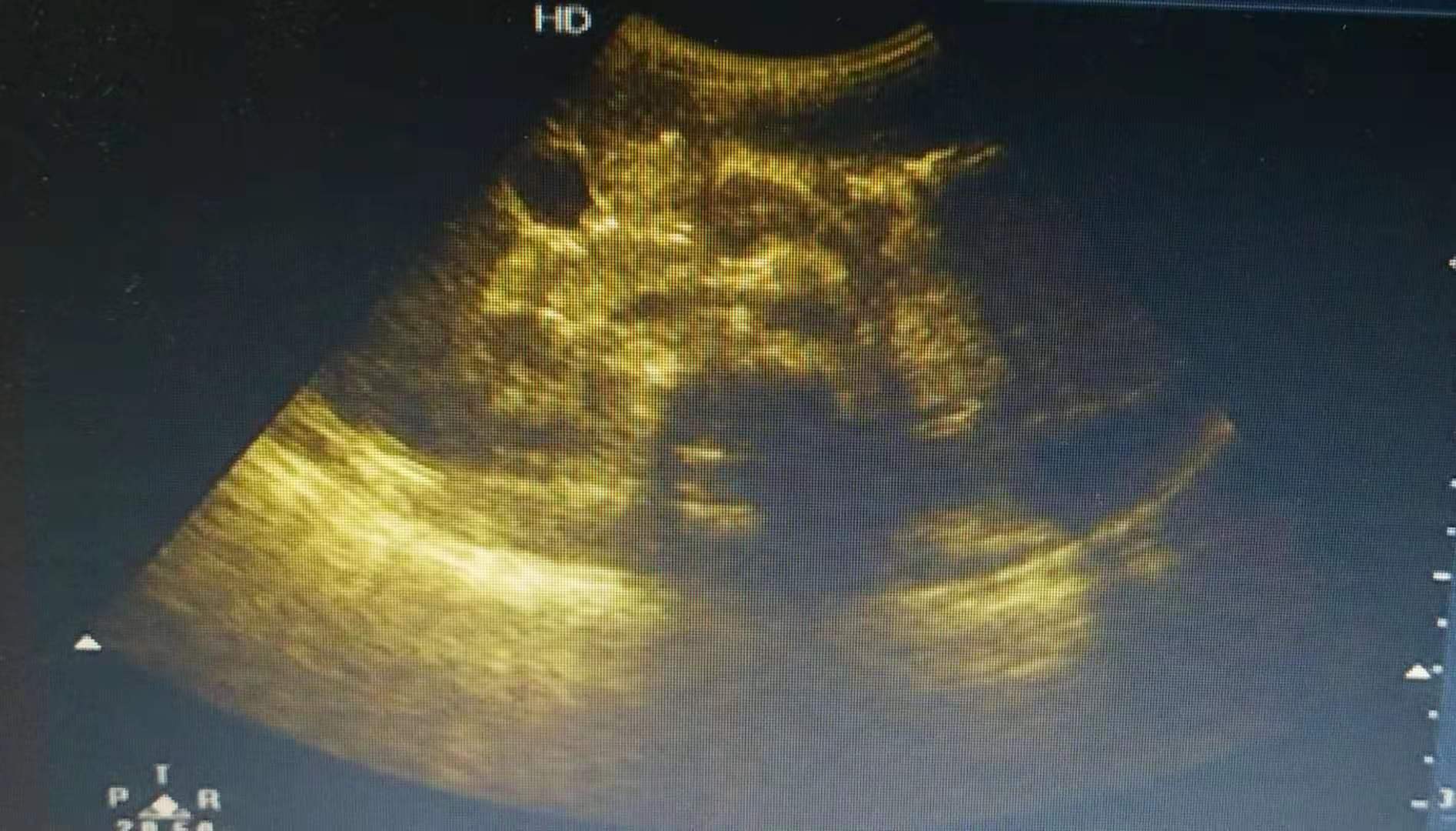 4岁儿童急性腮腺炎症状及表现,流行性腮腺炎使颌下腺肿痛