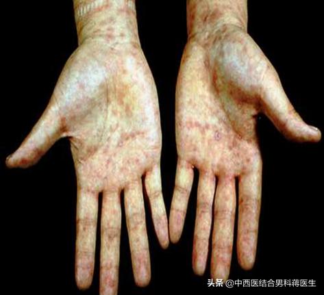 除了艾滋病,这4种常见性传播疾病你了解吗?