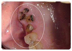 牙齿残根拔掉有什么危害吗,牙齿残根残冠要不要拔掉