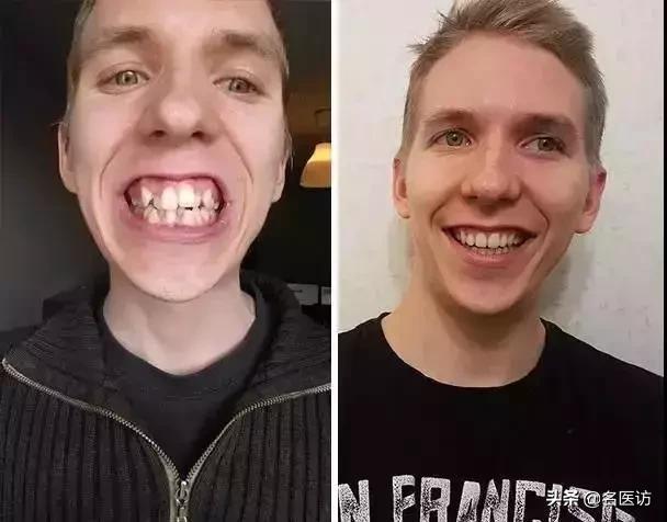 牙齿矫正换脸视频,牙齿矫正颜值有多大改变图片