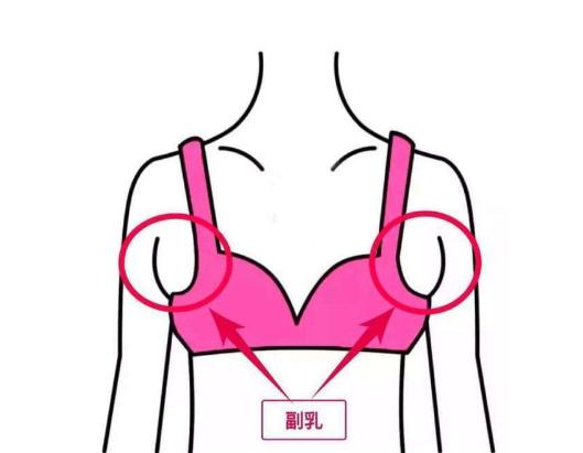 产妇腋下副乳硬块怎么消除才正确,副乳就是腋下的两坨赘肉
