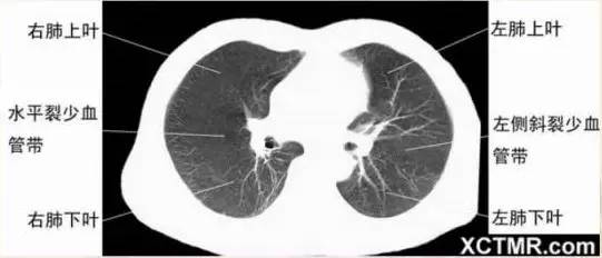 女性盆腔ct断层解剖结构图,女性盆腔脏器ct解剖