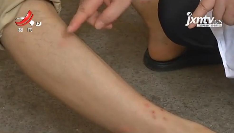 小区人身上痒,小区人身上奇痒无比