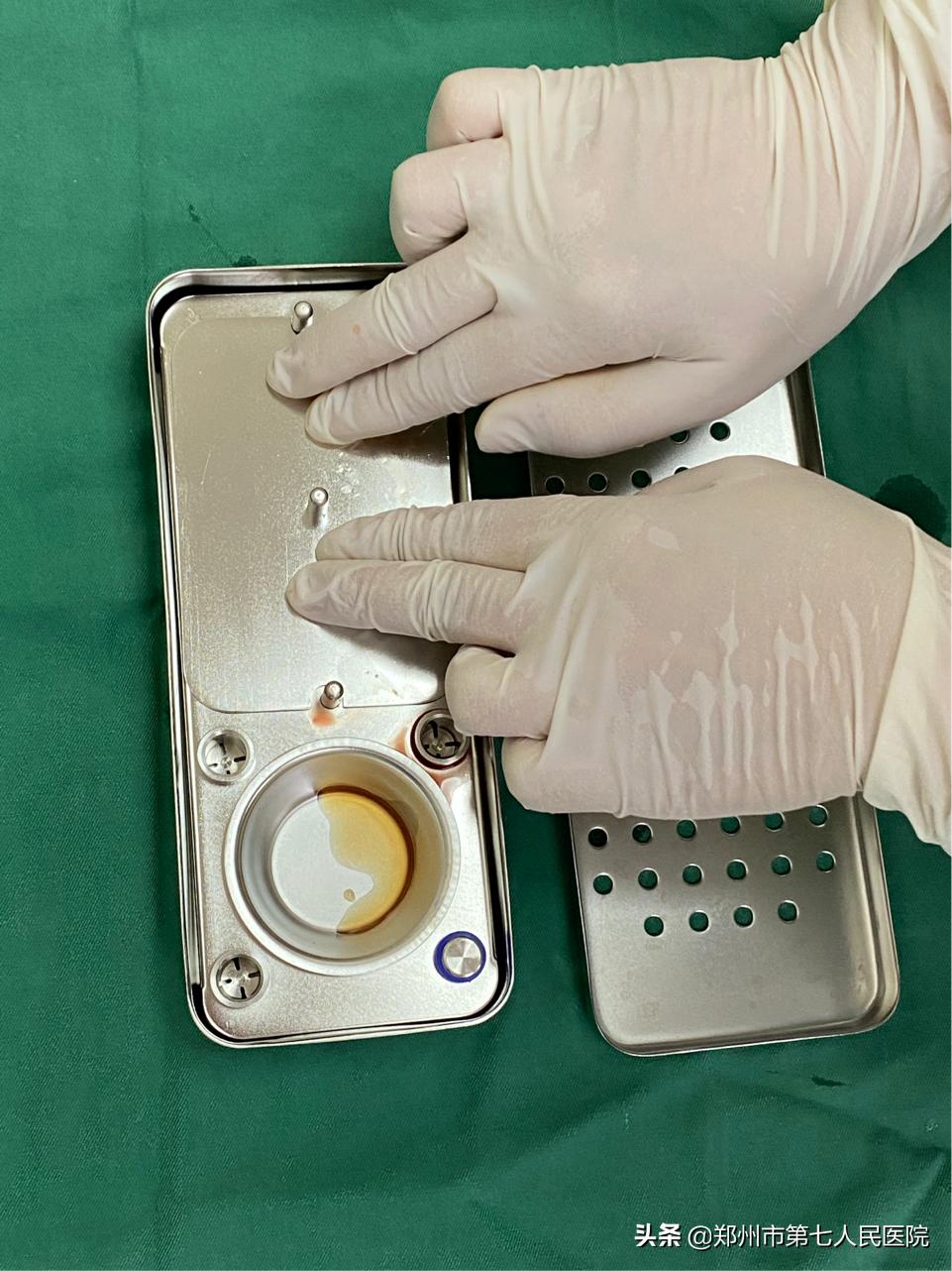 看牙也抽血?什么是CGF?