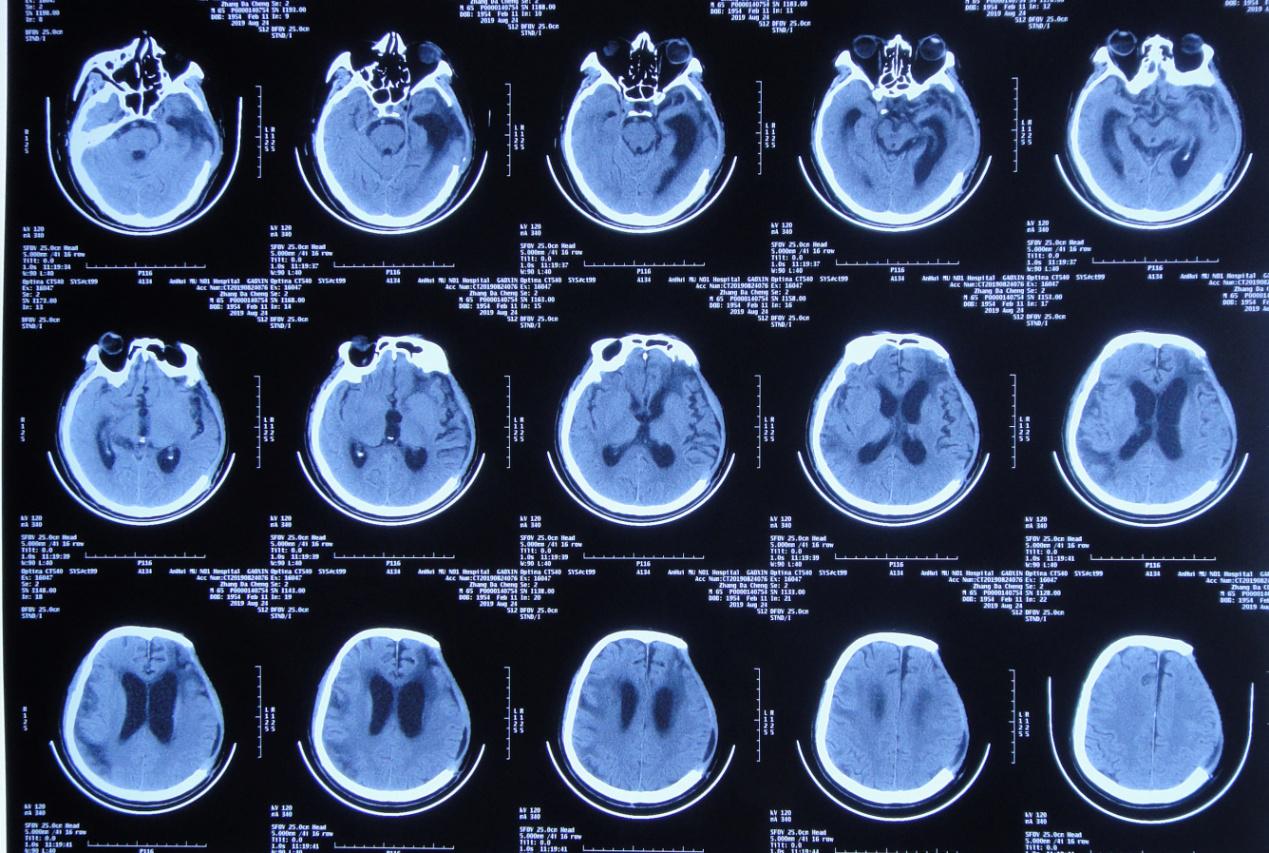 颅脑外伤术后脑积水,脑外伤脑积水颅骨缺失