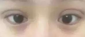 男生割眼皮术后,男性割眼皮后1-7天恢复图