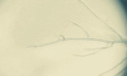 处理发霉的东西会被霉菌传染吗,护理不当造成的后果