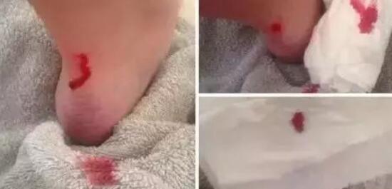 鞋子磨脚处理的简单方法图片,透明拖鞋脚底板磨脚怎么办