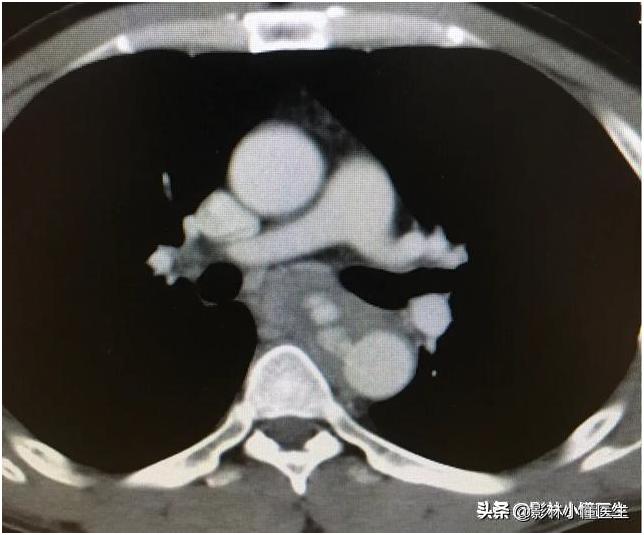 误吞假牙吃什么有助于排出,误吞假牙怎么处理