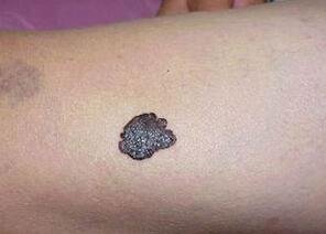 警惕身体出现的3种痣,哪些痣不容易癌变