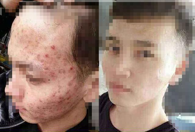 脸部爱出油怎么控油,脸部爱出油吃什么管用