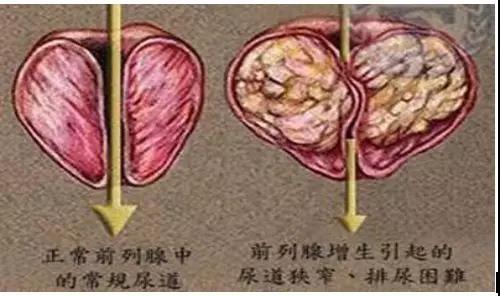 泌尿外科治疗前列腺增生常用药物,山西省人民医院泌尿科前列腺增生