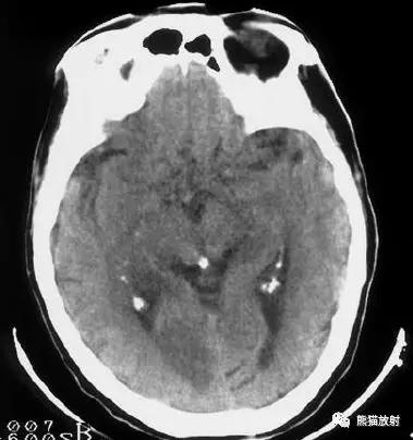 各部位脑梗死ct影像讲解,脑梗死ct影像最简单的是什么表现