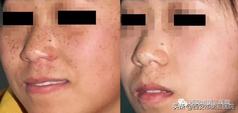 光子嫩肤的魅力,光子嫩肤带你美下去