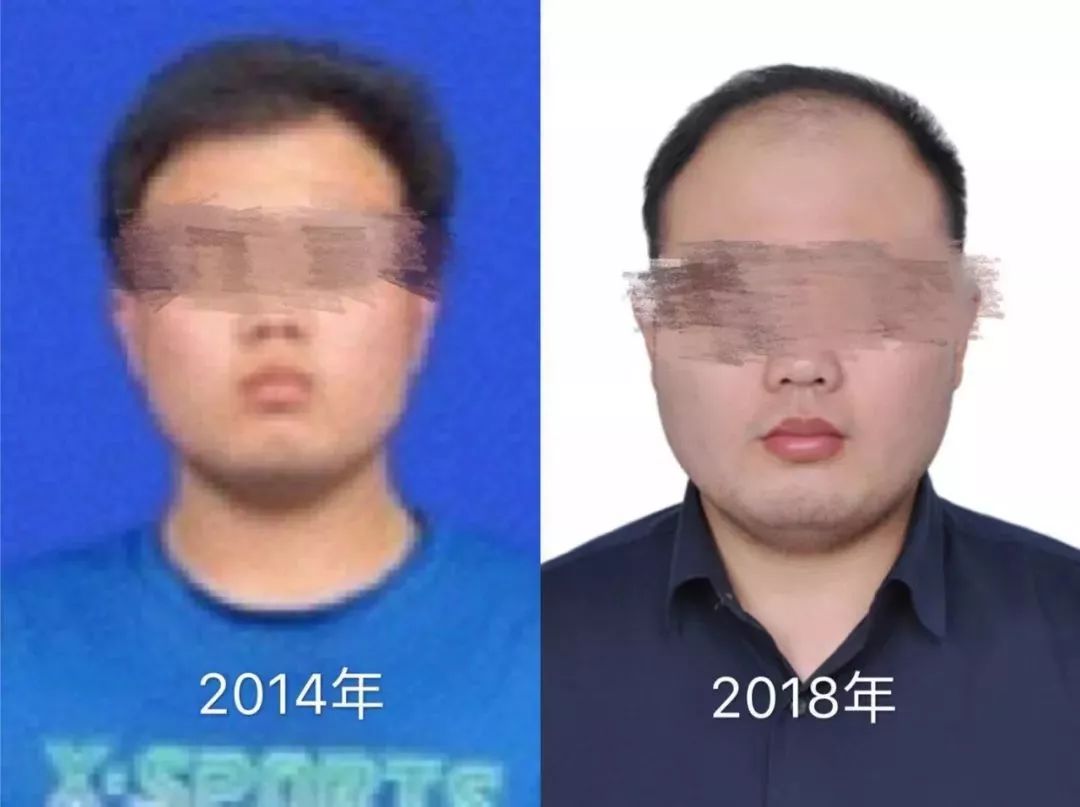 脱发科普宣讲,关于脱发越来越年轻化原因