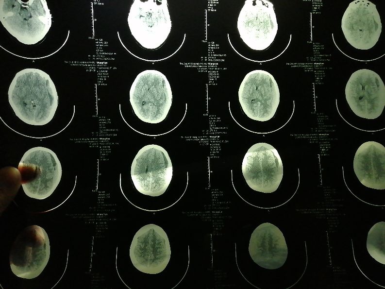 安医二附院生娃后老婆颅内硬膜下血肿伴视力模糊该找谁!