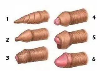 关于包皮包茎疾病的介绍,包茎通俗易懂的解释