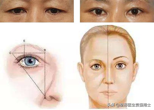 提眉手术拆线疼不疼,提眉手术20多天了怎么还感觉疼